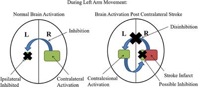 Role of the Contralesional vs. Ipsilesional Hemisphere in Stroke Recovery